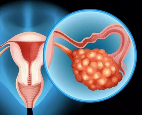在卵巢囊肿中一般常见的都有哪些类型呢?