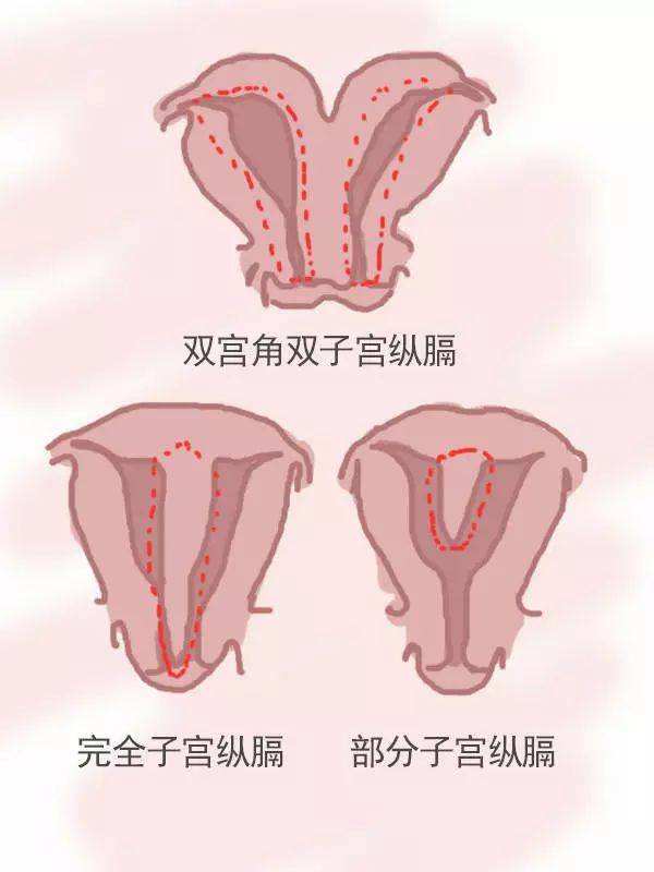 子宫畸形不完全纵膈怎么确诊？