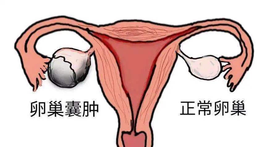 女孩查出卵巢囊肿，这3个卵巢健康的自测方法要掌握