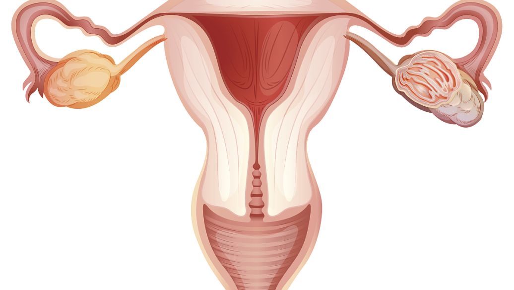 双侧卵巢多囊样改变是什么意思，严重吗？
