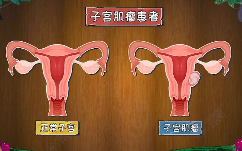 子宫肌瘤多大算严重，超过5厘米是很严重了吗