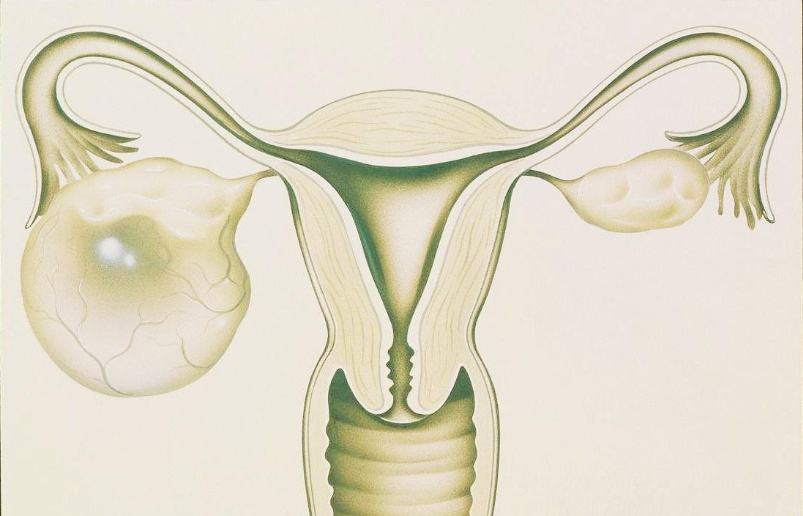 卵巢巧克力囊肿是怎么引起的，要如何避免