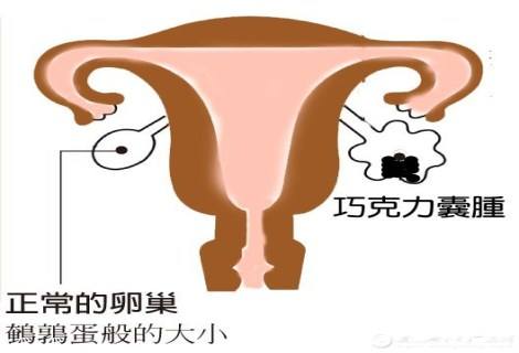 卵巢巧克力囊肿是怎么引起的，要如何避免