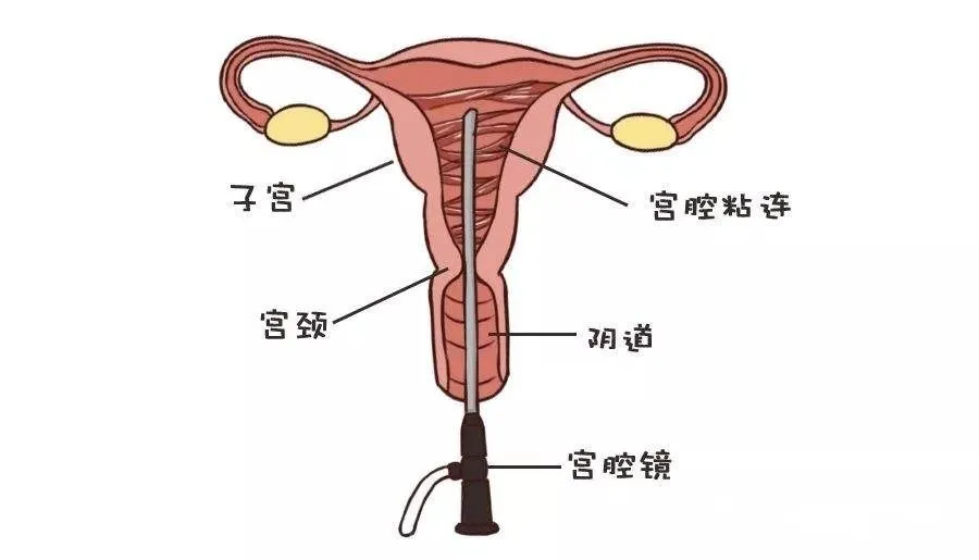 宫腔粘连术后内膜多少才可以怀孕？