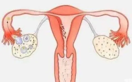 右卵巢卵泡多于10个什么意思