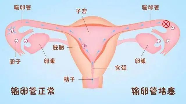 输卵管好不好,到底应该怎么查呢?