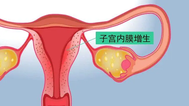 子宫内膜增生症的临床表现有哪些？