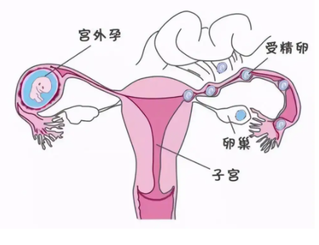 输卵管通不通怎么检查出来 一侧不通能怀孕吗