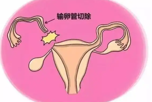 输卵管切除一边怀孕几率有多少 如何提高怀孕几率