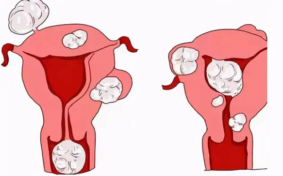 子宫腺肌症影响生育吗1
