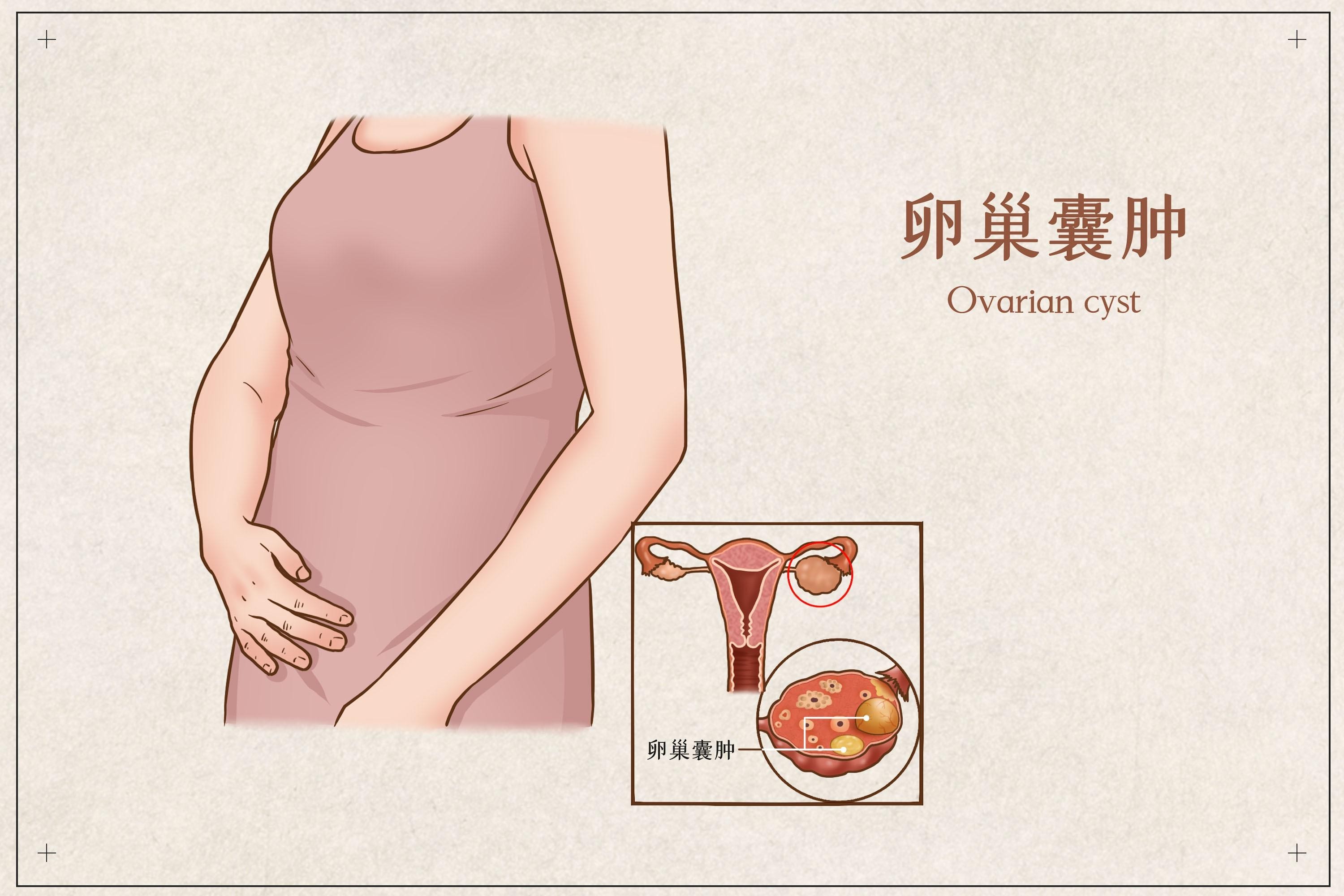 卵巢囊肿会影响女性怀孕吗