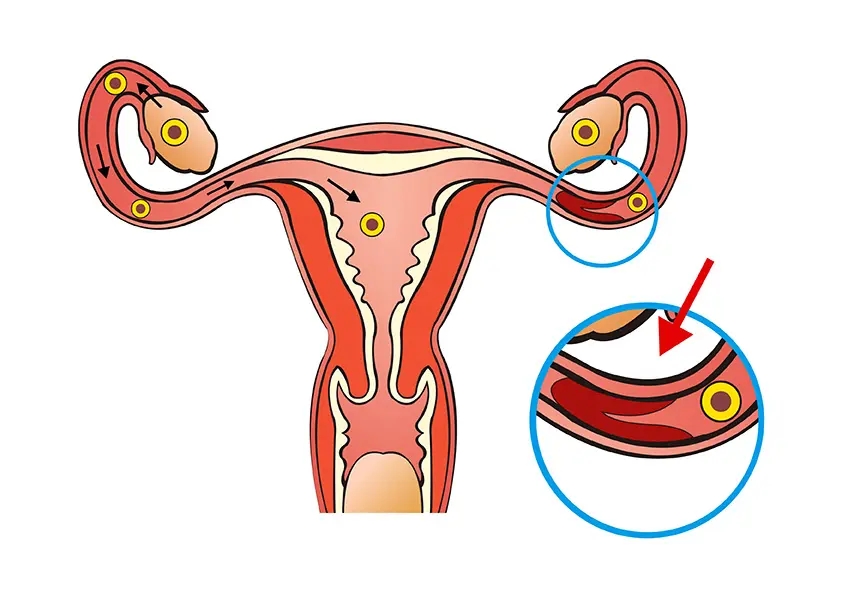 女性输卵管通而不畅是什么原因导致的