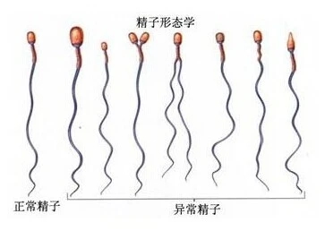 精子异常引起的不育怎么预防