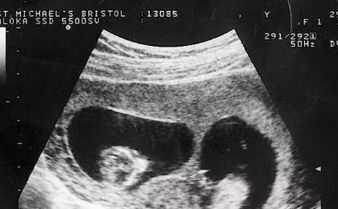 龙凤胎早期孕囊b超图片分享，形状一长一圆也无法准确分辨