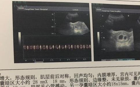 龙凤胎B超有4大特征，B超图与双胞胎的区别要知晓