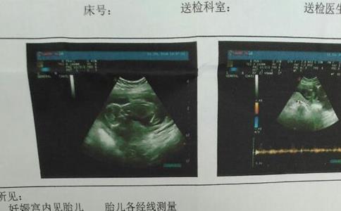 HC和AC标准值对照表参考，男女胎儿无明显差异
