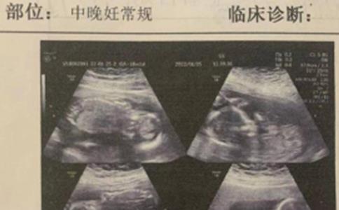 山东一孕妇身怀四胞胎，为什么老大老二先出生了