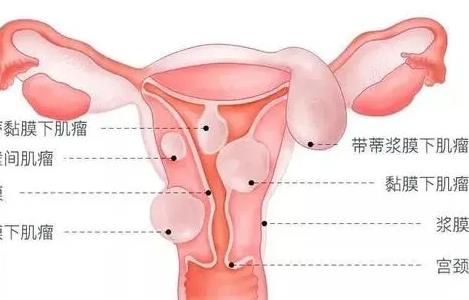 1／4的不孕均与子宫肌瘤有关，若月经量多就得小心了！