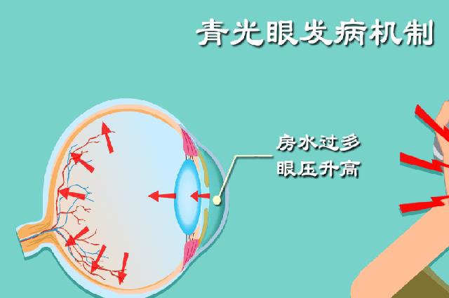 青光眼不能吃食物列表，这6类食物最好不要沾