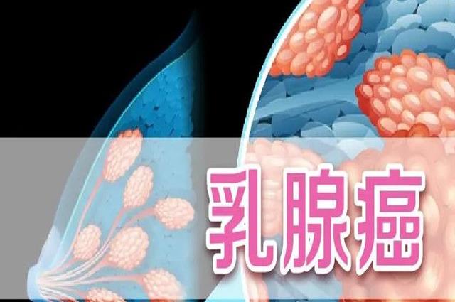 乳腺增生和乳腺结节有什么区别？快来听听专家讲解二者间的不同