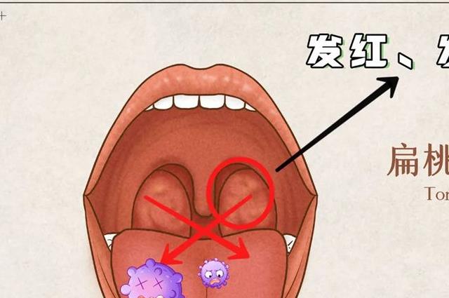 扁桃体发炎快好的4个征兆，恭喜你很快就可以继续活跃了