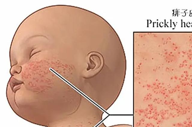 健康指南：治痱子的7个好方法，让你不再被痱子困扰