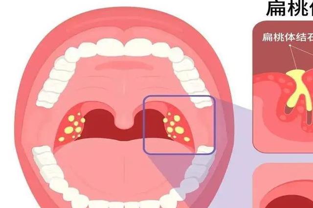 扁桃体结石是什么原因引起的？多半是这六个原因在作怪