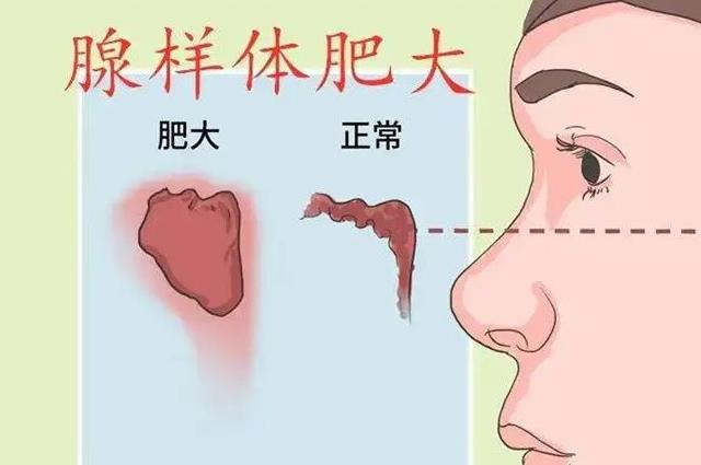 腺样体肥大引起的原因是什么？这五大诱因家长一定要知道