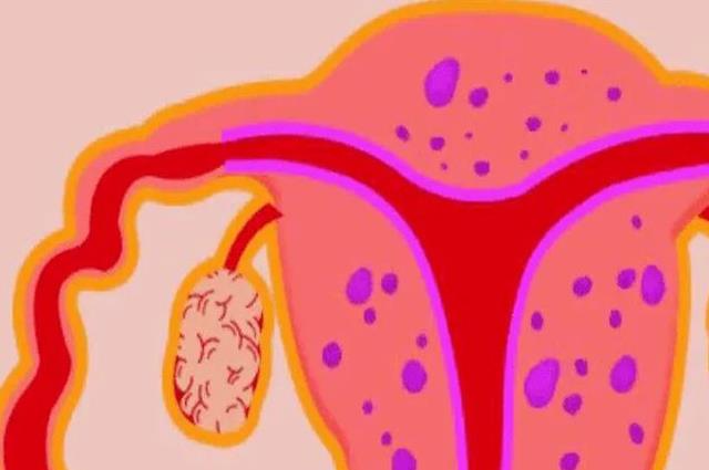 子宫腺肌症备孕需要注意什么？这四点是重中之重