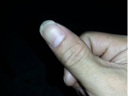 手指甲上有黑色竖纹是怎么回事，这4个原因千万别忽视！