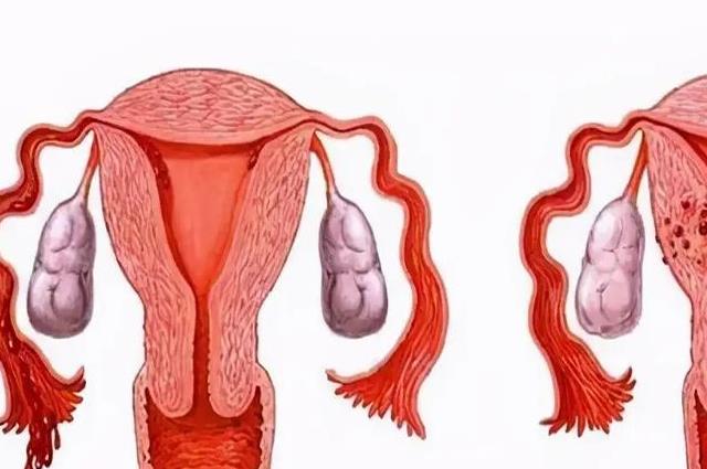 备孕科普：子宫腺肌症的5大最佳治疗方法，医生一语道破