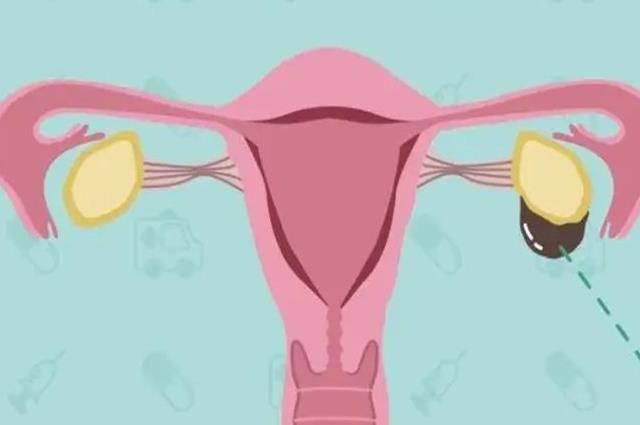 子宫内膜异位症可以自然怀孕吗？医生一般不告诉你