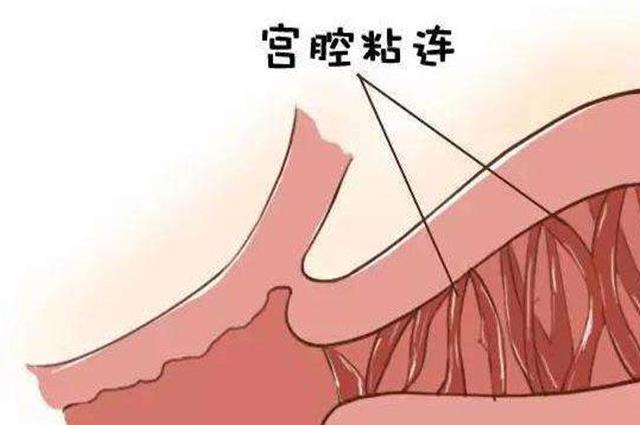 宫腔粘连能怀上孩子吗？依然有机会拥有属于自己的宝宝