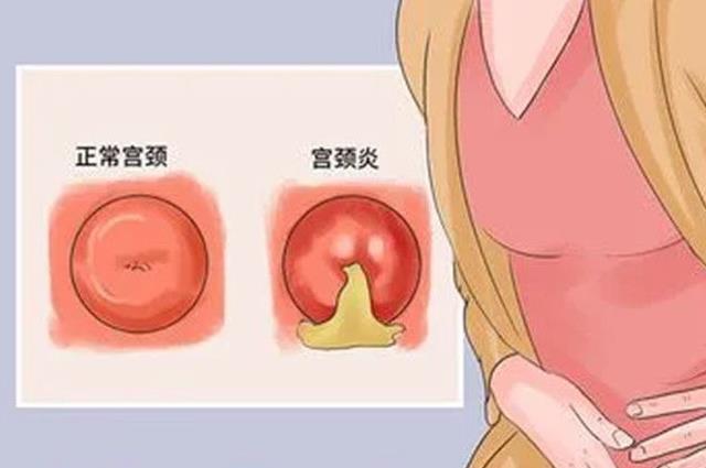 宫颈糜烂有什么症状和现象，这五种症状影响女人一生