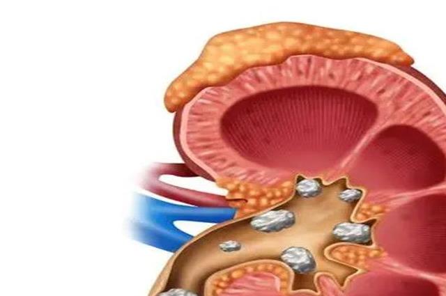 肾结石不宜吃6种水果，否则不利病情恢复