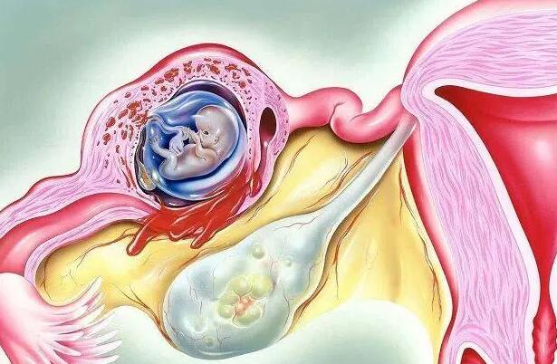 宫外怀孕了打掉的最佳时间？宫外孕什么时候打掉好？