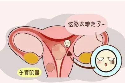 子宫肌瘤的早期症状有哪些
