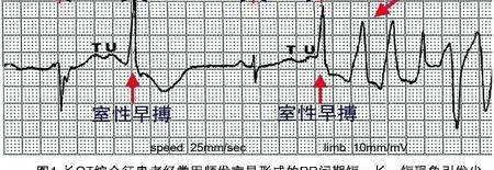 长QT间期综合征