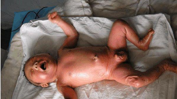 预防火棉胶婴儿出现很简单，做好产前诊断即可