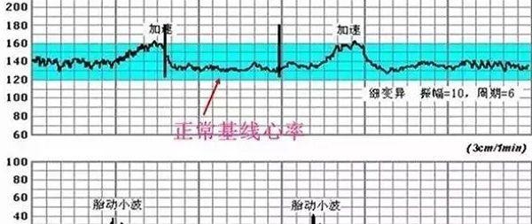 胎心监护