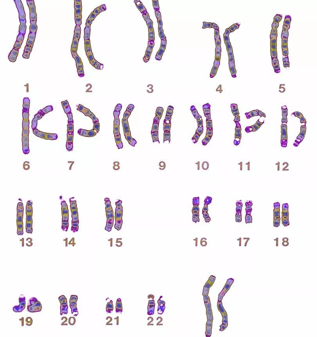 21号染色体异常和唐氏综合症关系不小，你肯定知道
