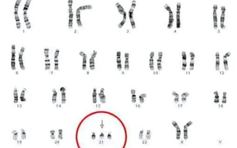 21号染色体异常和唐氏综合症关系不小，你肯定知道