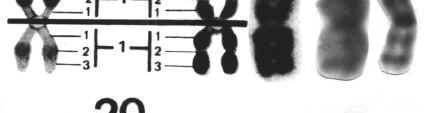 20号染色体异常要重视，这3种遗传病和它有关系