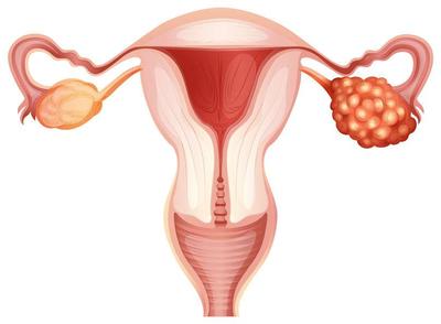 子宫内膜癌术后放疗需要输液吗，杜仲壮骨胶囊对子宫囊肿有影响吗