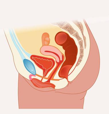 缺血性子宫内膜炎中医如何治疗，子宫后位会引起子宫内膜异位吗