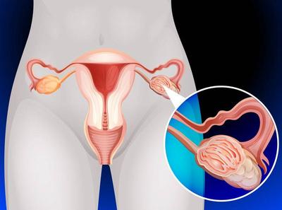 瞿麦子宫肌瘤可以喝吗，子宫内膜癌可以腹腔镜切碎子宫吗