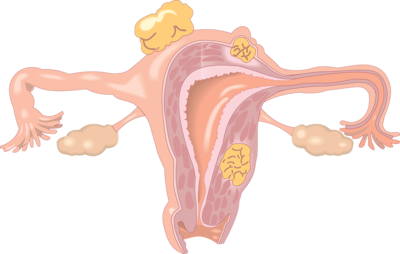孕晚期子宫肌瘤不见了的可能性有多大，子宫内膜下肌瘤有什么危害 六种危害伤害着患者