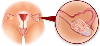 重庆医院恶性的卵巢囊肿吃药会变小吗