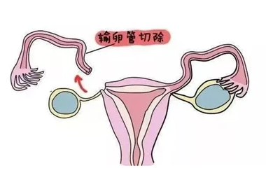 女性一侧输卵管